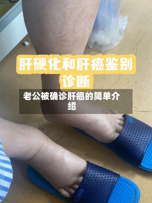 老公被确诊肝癌的简单介绍-第2张图片